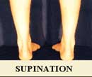 Supinated Foot